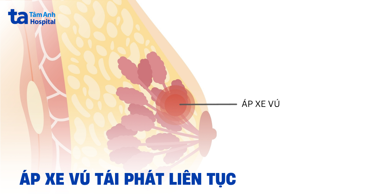 Nguyên nhân áp xe vú tái phát liên tục và cách phòng ngừa