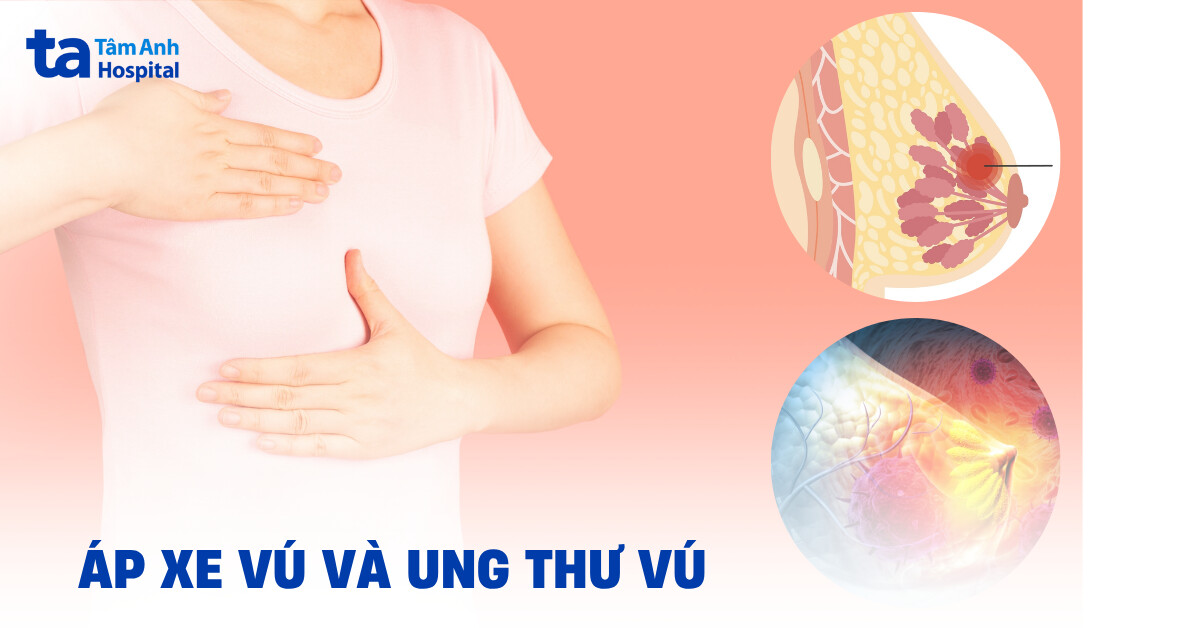 Áp xe vú và ung thư vú: Vì sao dễ nhầm lẫn?