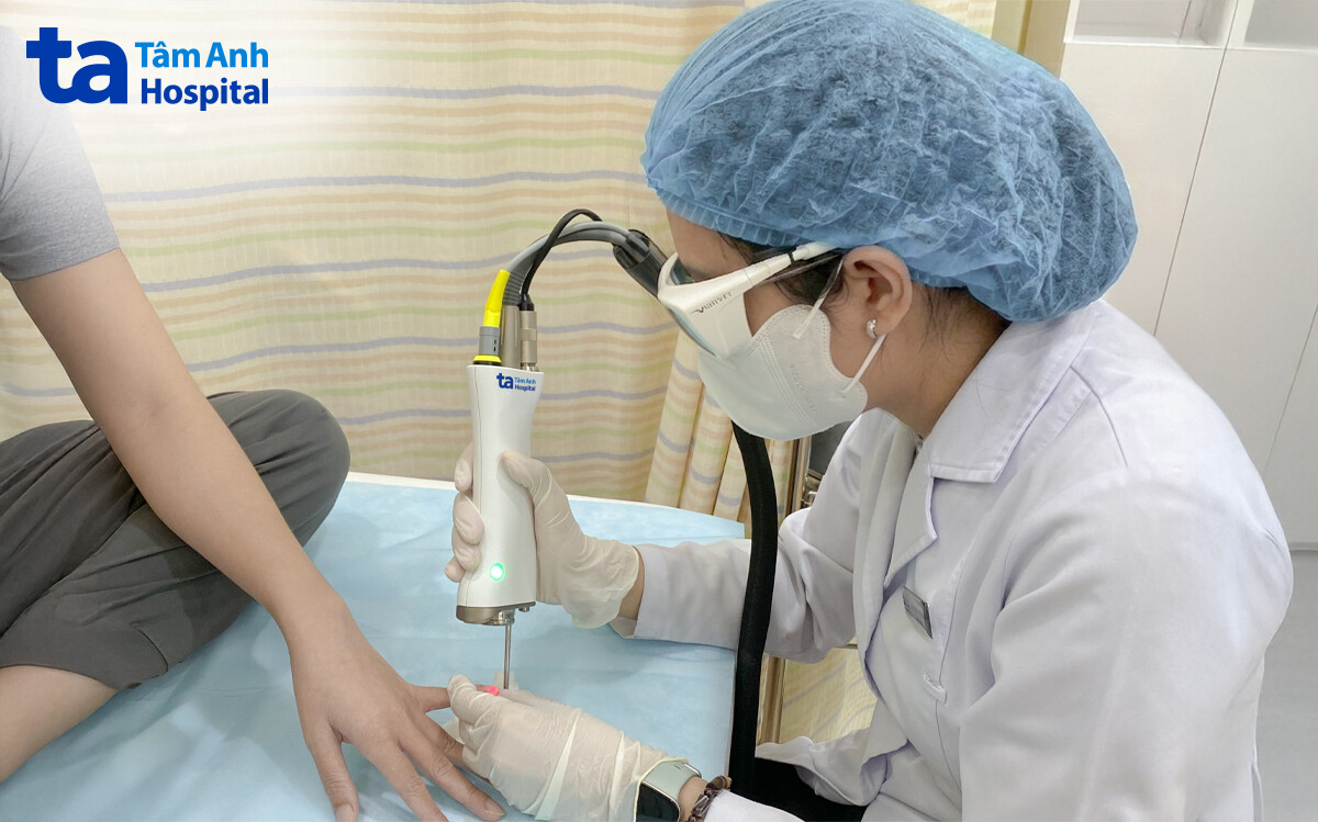 bác sĩ sử dụng laser 6d điều trị nấm móng cho chị mỹ