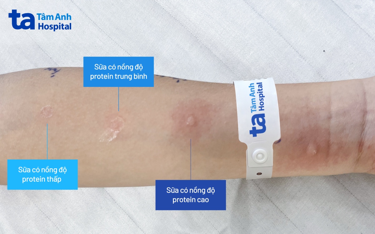bác sĩ thực hiện test lẩy da để xác định các loại sữa gây ra phản ứng cho phát