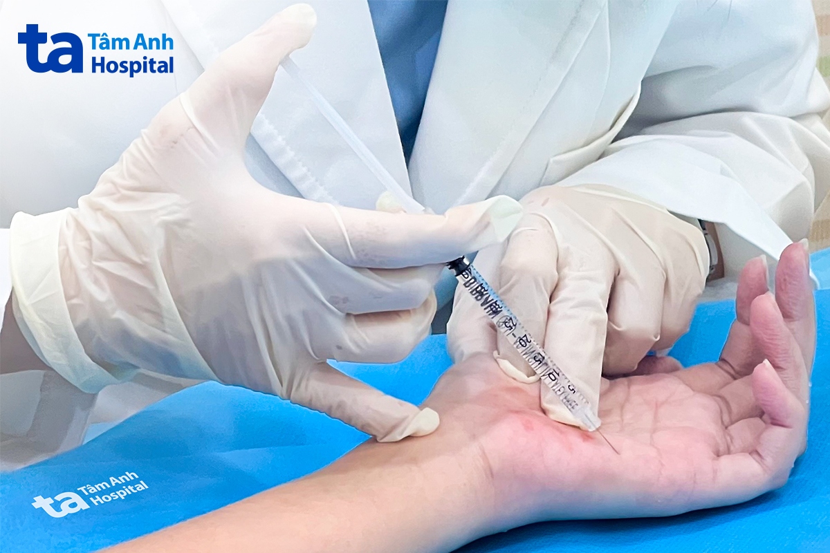 bác sĩ tiêm botox điều trị tình trạng tăng tiết mồ hôi tay cho thúy