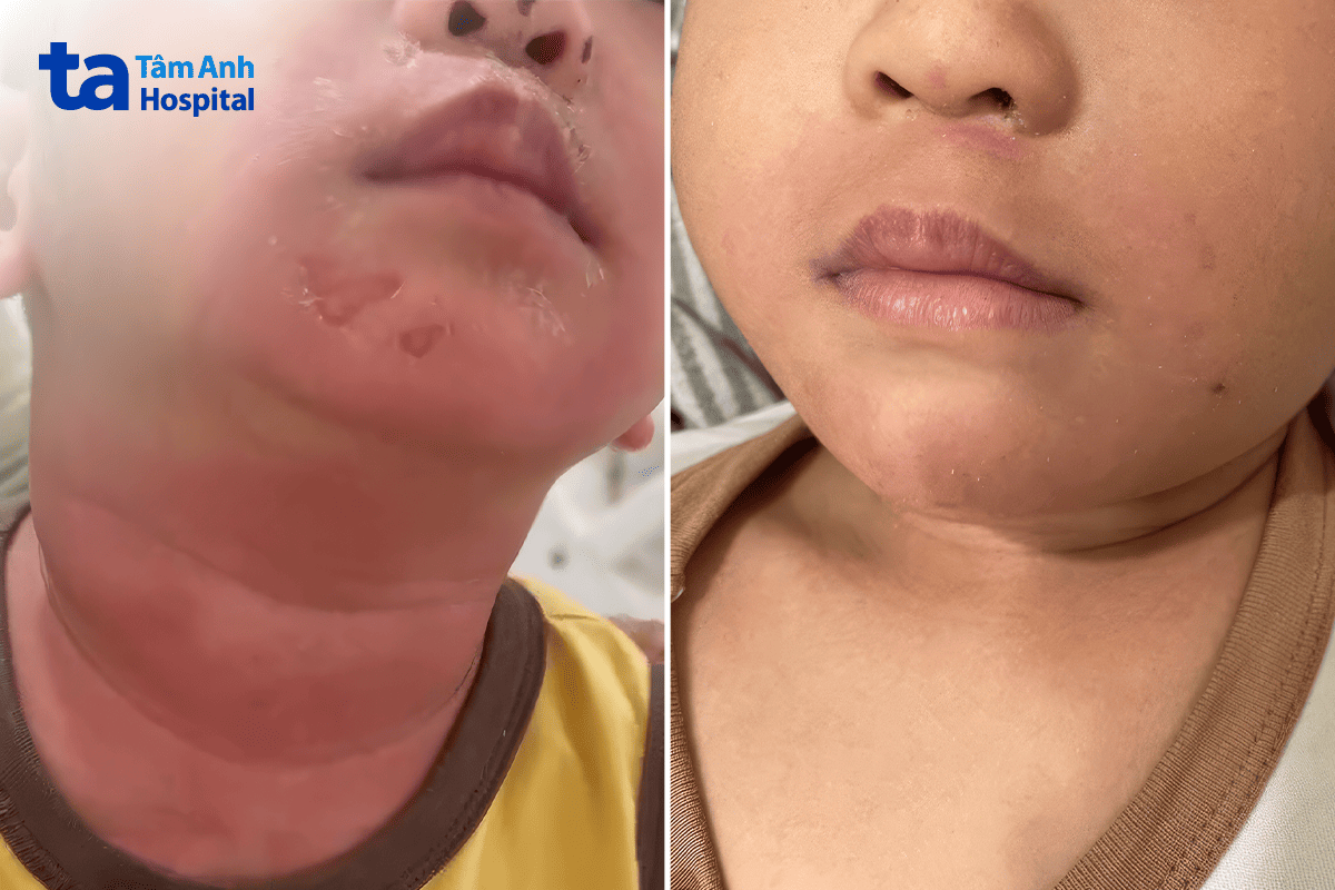 hình ảnh vùng da quanh miệng lúc nhập viện và sau điều trị