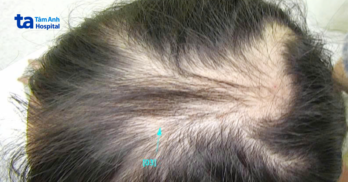 Bé gái mắc hội chứng nghiện giật tóc