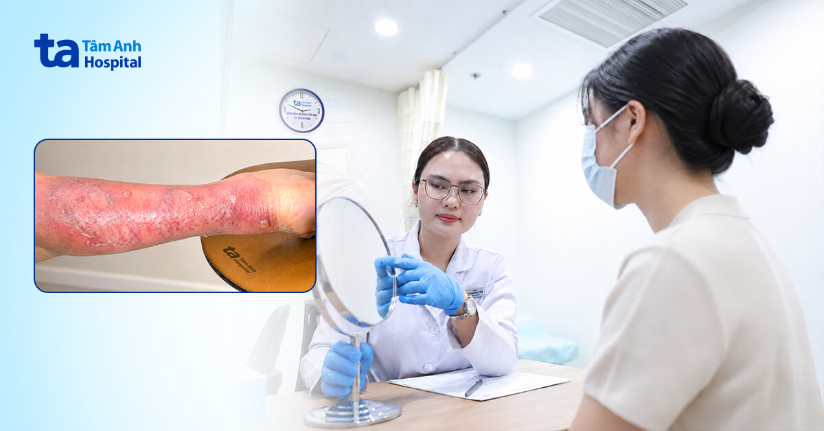 Bỏng dầu ăn gây loét kéo dài