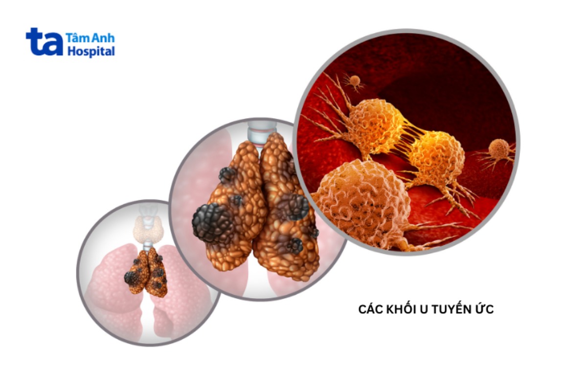 các khối u tuyến ức