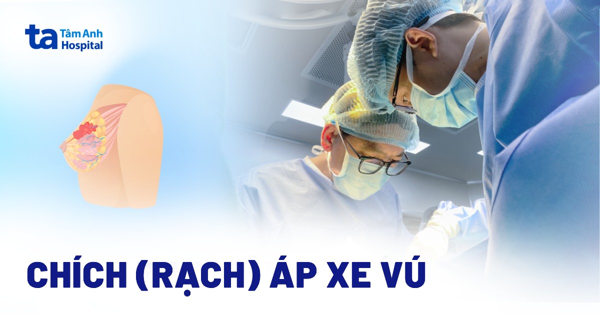 Chích áp xe vú (rạch): Chỉ định khi nào?