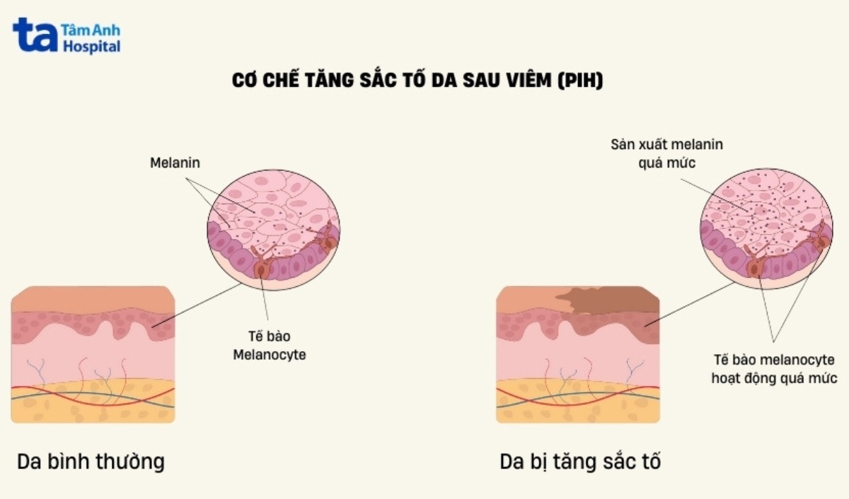 nguyên nhân gây tăng sắc tố da sau triệt lông