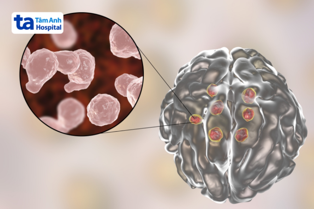 viêm màng não do nấm cryptococcus