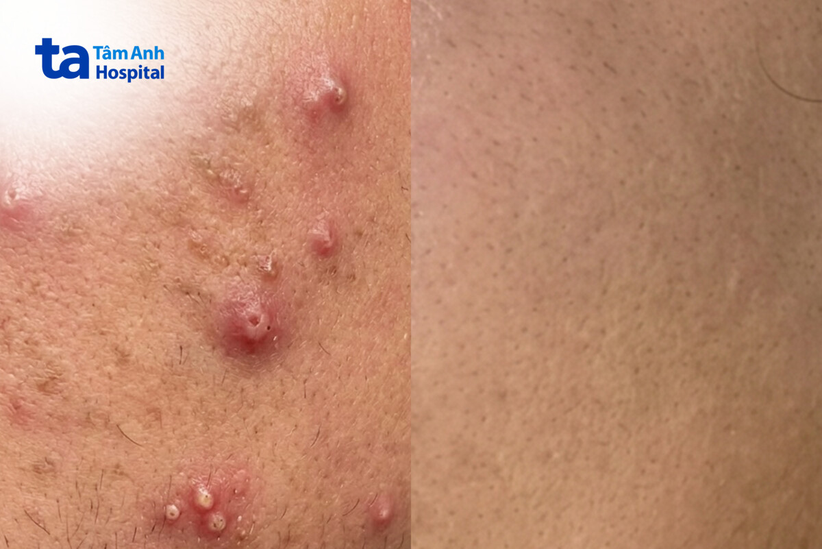 da cải thiện sau 2 liệu trình điều trị