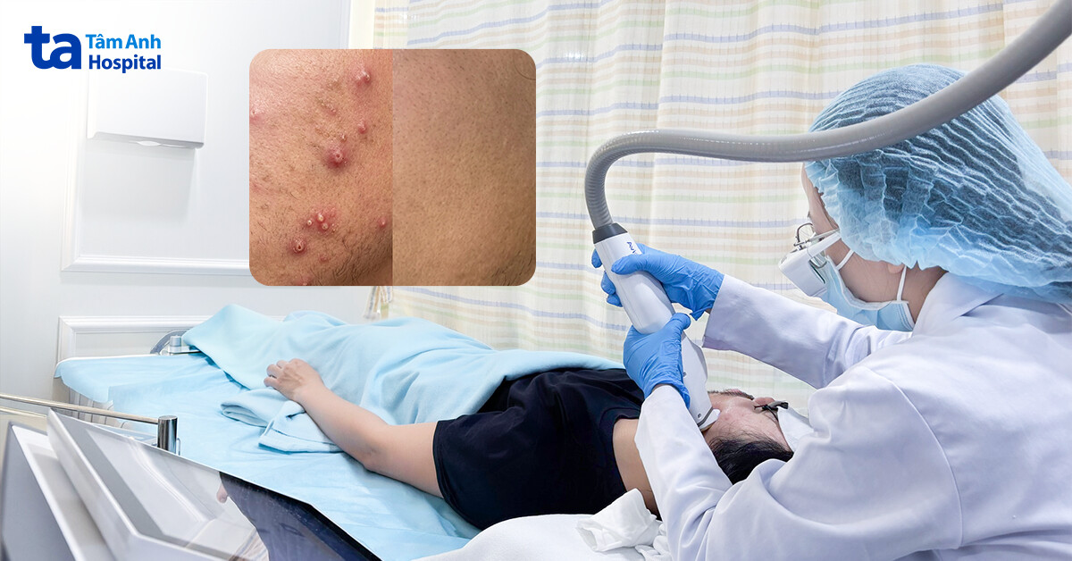 Da đỏ như say rượu vì tự trị mụn sai cách