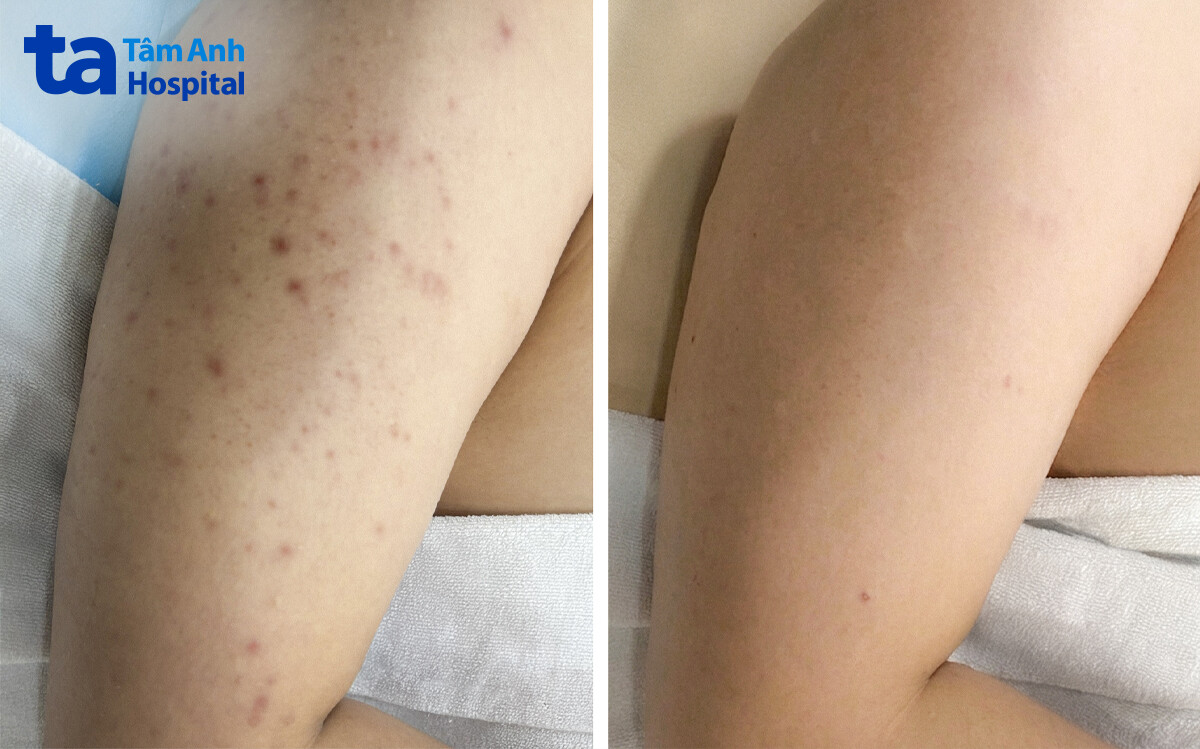 da phục hồi sau 5 lần điều trị