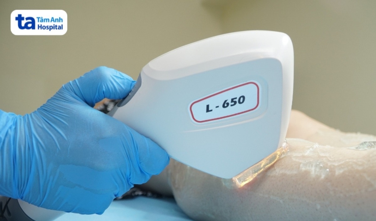 laser điều trị tăng sắc tố da sau triệt lông