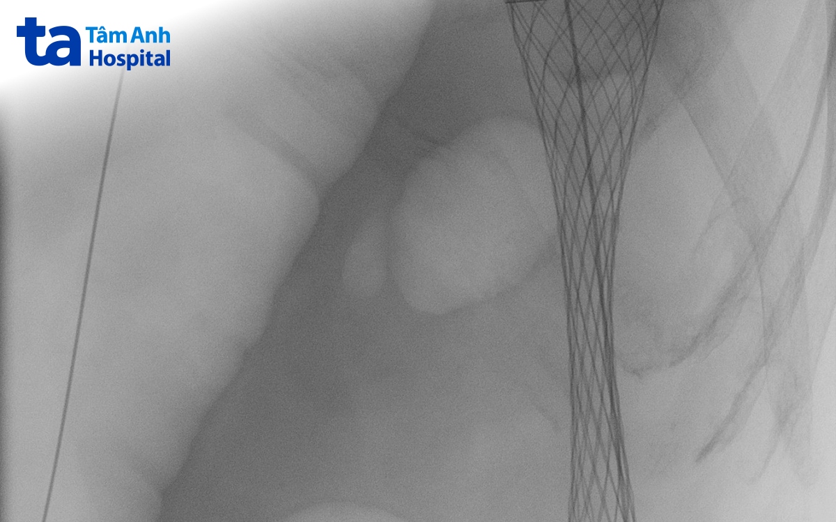 đặt stent kim loại