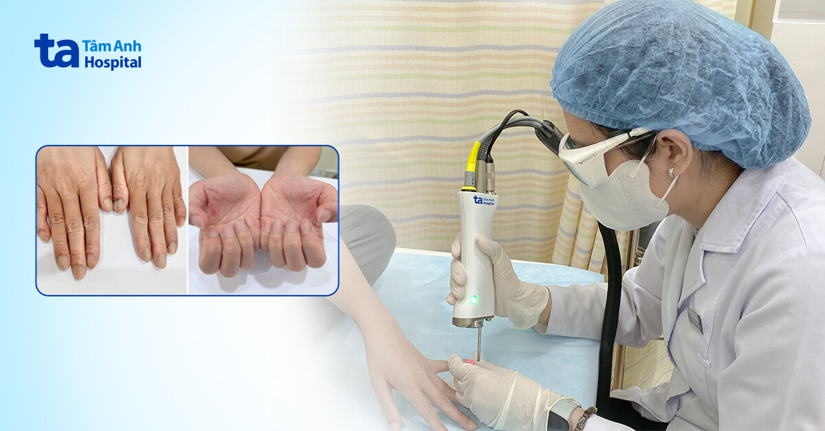 Hết nấm móng nhờ điều trị công nghệ cao