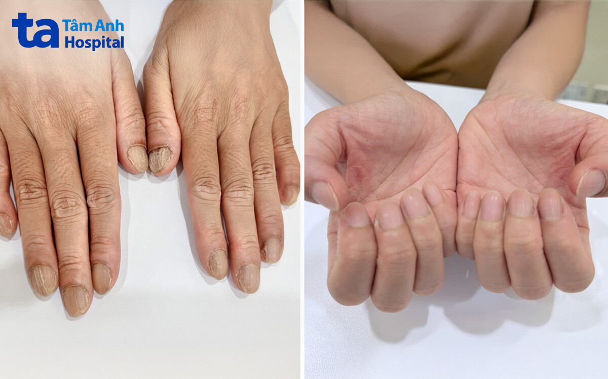 hết nấm móng sau gần 1 năm điều trị