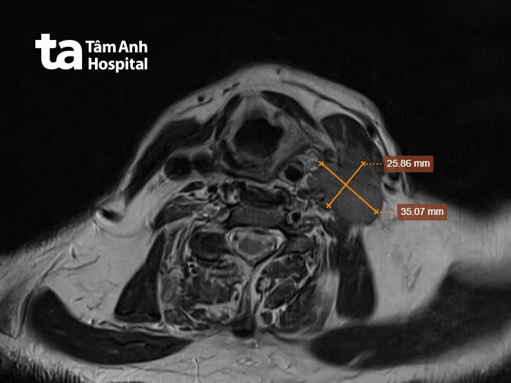 hình ảnh ct u xoang lê