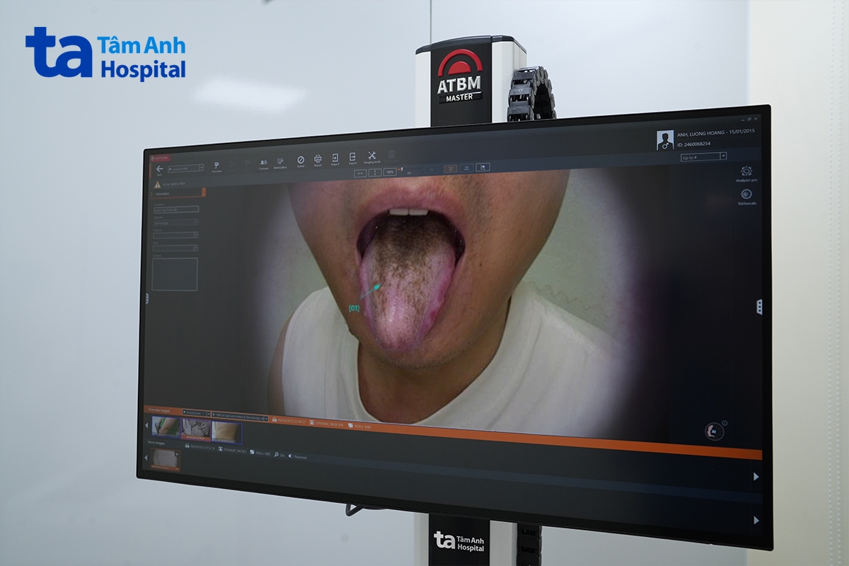 hình ảnh dải tăng sắc tố màu nâu đen và các gai