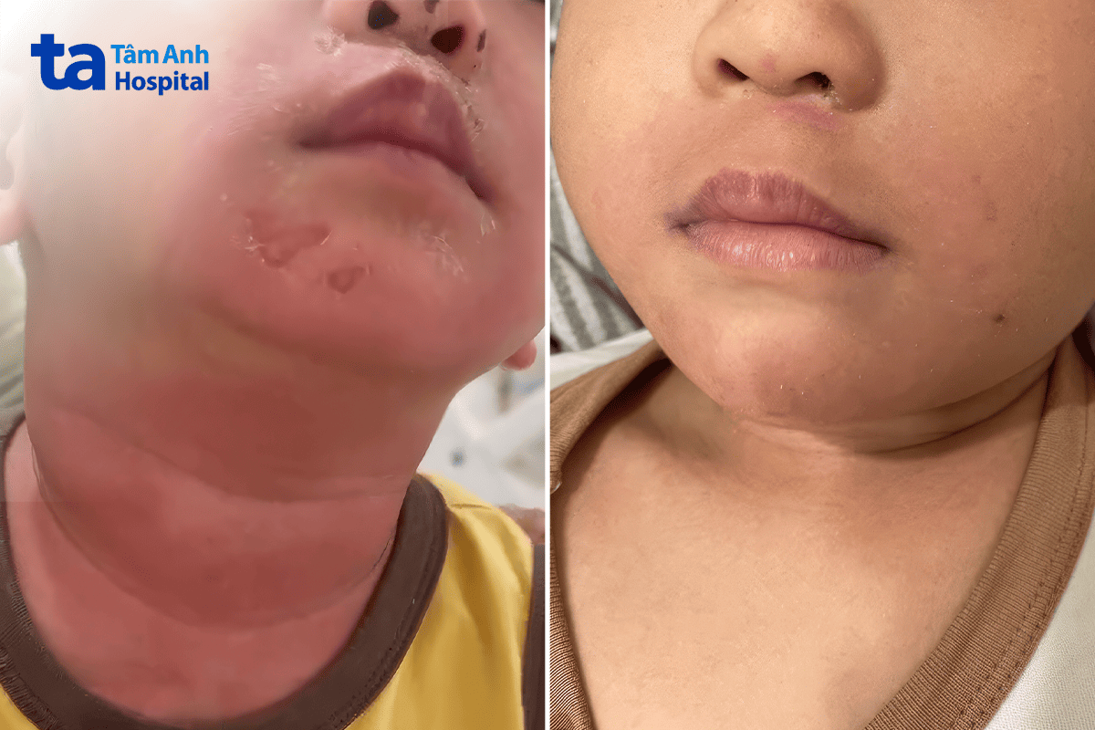 Bé 2 tuổi bong tróc da toàn thân do độc tố tụ cầu khuẩn