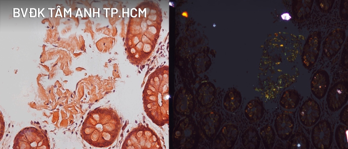 hình sinh thiết tinh thể Amyloid