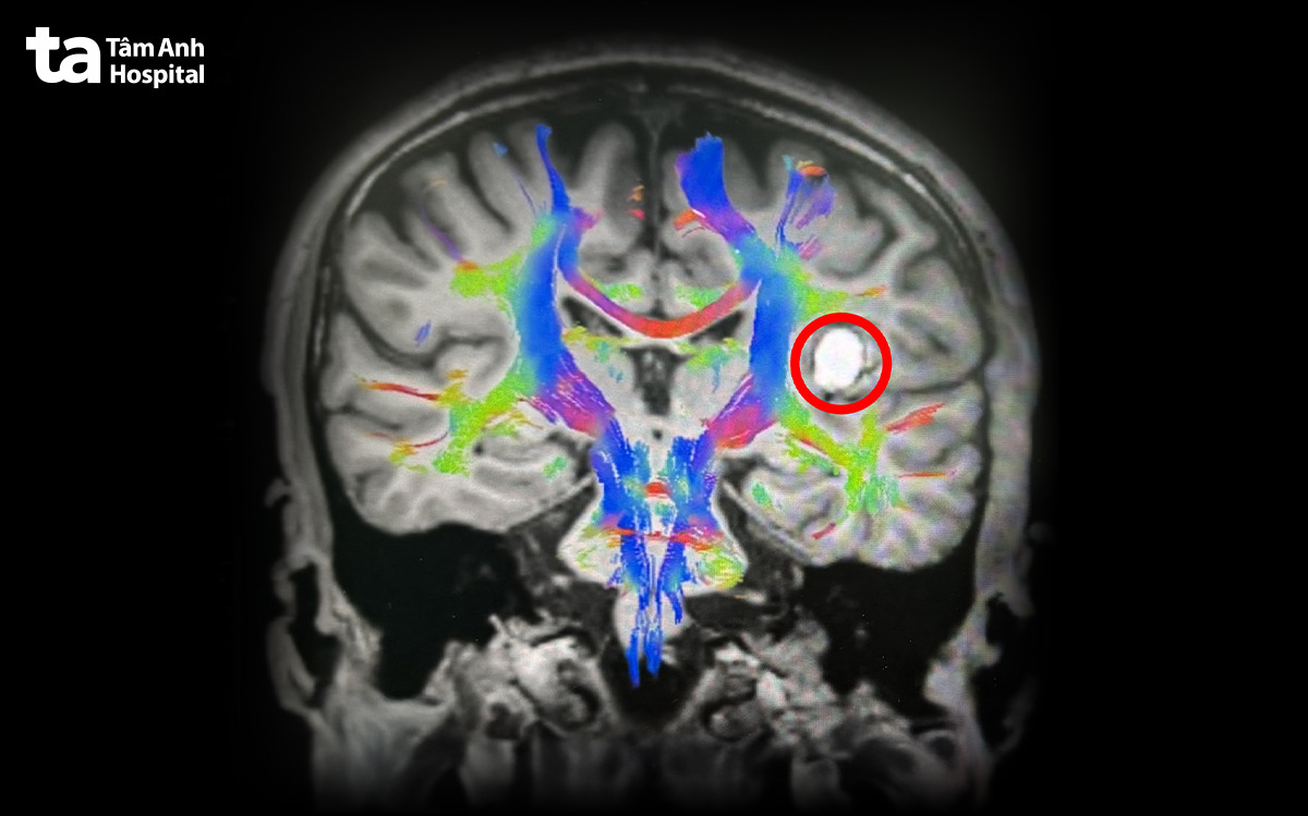 khối u nằm gần các vùng não quan trọng trên mri