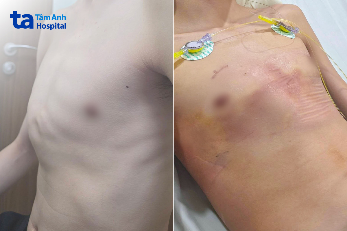 Lồng ngực nam sinh trước (trái) và sau khi phẫu thuật tạo hình (phải)