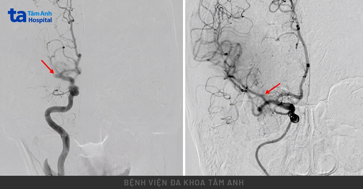 mạch máu não của ông Văn bị tắc
