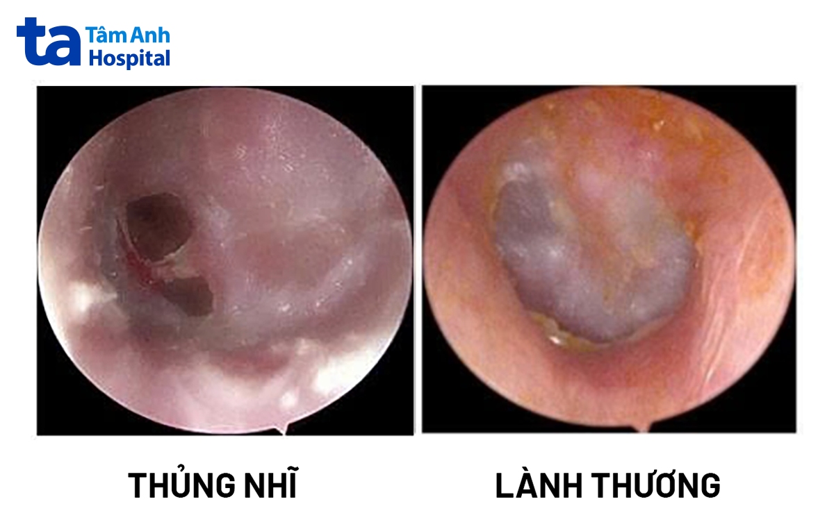 màng nhĩ tai trái bị thủng