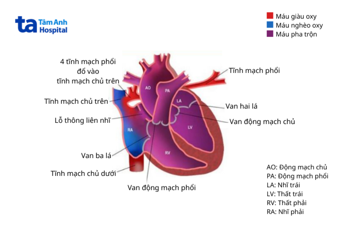 Minh Họa Bất Thường Hồi Lưu Tĩnh Mạch Phổi Toàn Phần