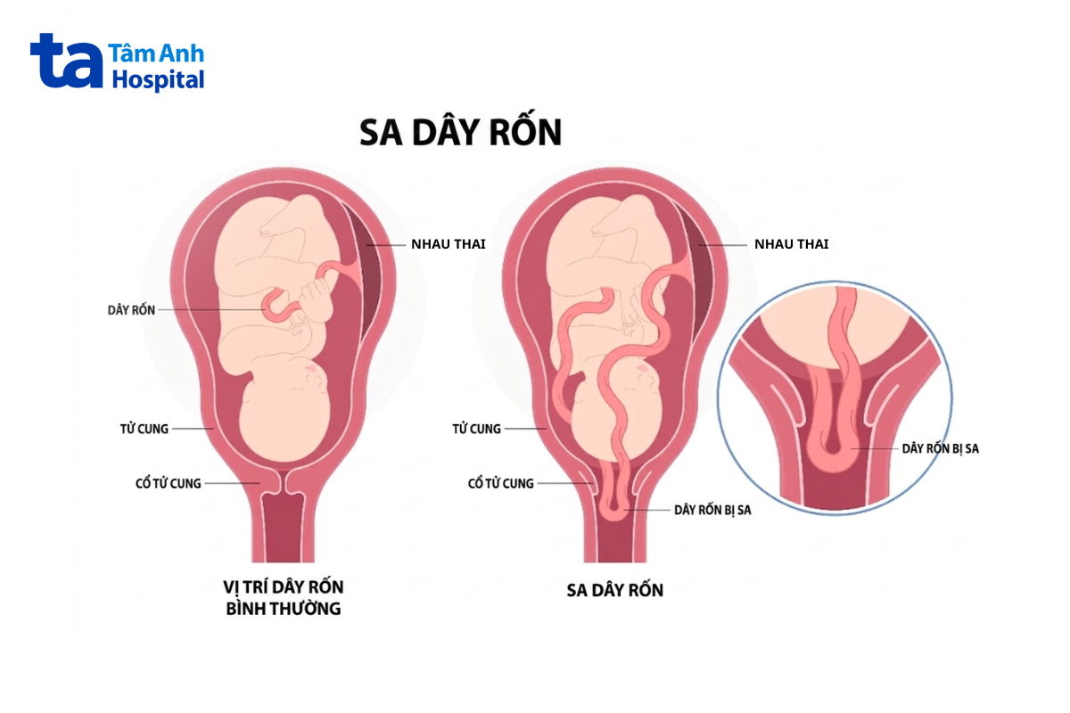 Hình minh họa vị trí dây rốn bình thường và sa dây rốn