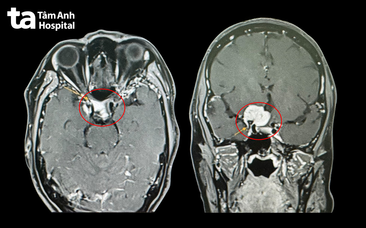 mri khối u não bà hoa