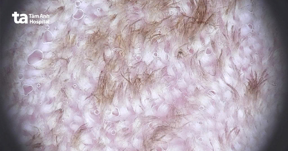 Người đàn ông mắc bệnh lưỡi lông