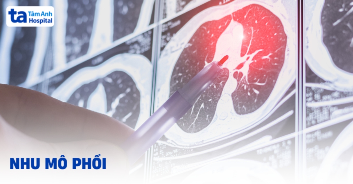 Nhu mô phổi là gì? Các bệnh lý liên quan