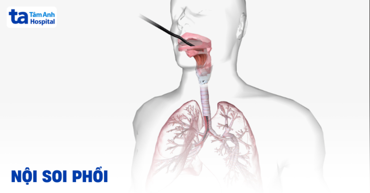 Nội soi phổi được thực hiện như thế nào? Cần lưu ý những gì?