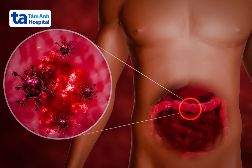 Norovirus là nguyên nhân hàng đầu gây tiêu chảy ở người lớn