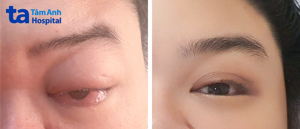 Tình trạng mắt trái của chị Thuyên trước và sau khi can thiệp DSA 1 ngày. Ảnh: Bệnh viện Đa khoa Tâm Anh