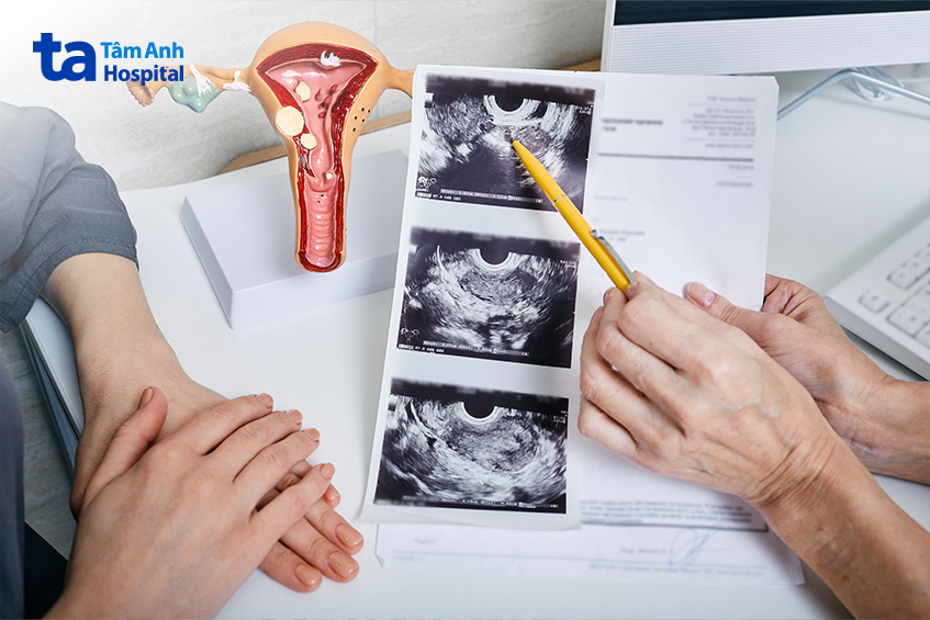 Siêu âm phụ khoa kiểm tra buồng trứng và tử cung