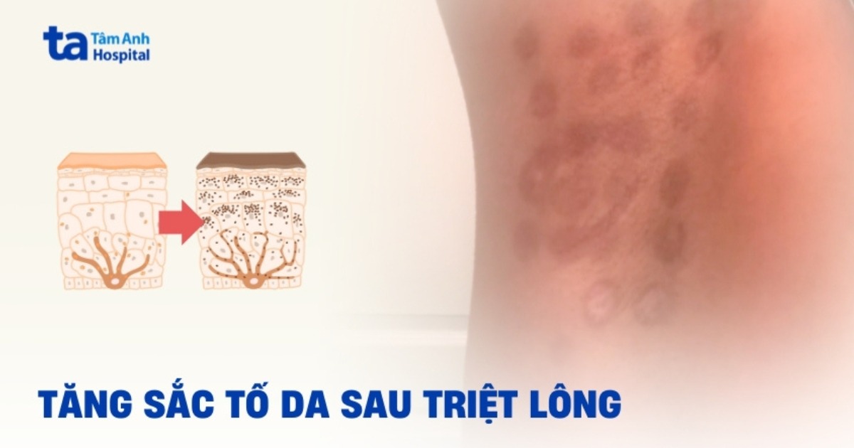 Tại sao bị tăng sắc tố da sau triệt lông? Điều trị ra sao?
