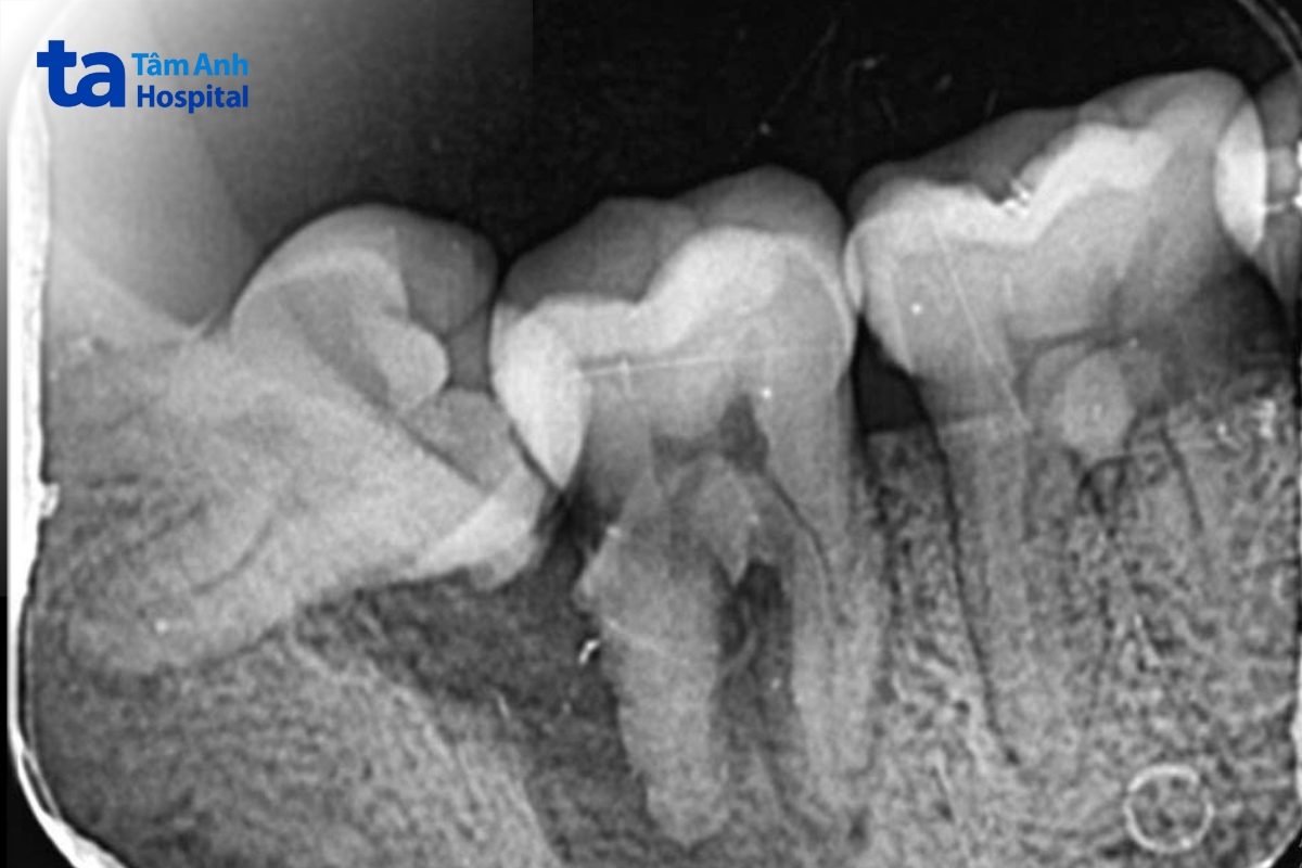 Kết quả chụp X-quang ghi nhận răng khôn mọc lệch gần 90 độ, đâm thẳng vào chân răng hàm bên cạnh.