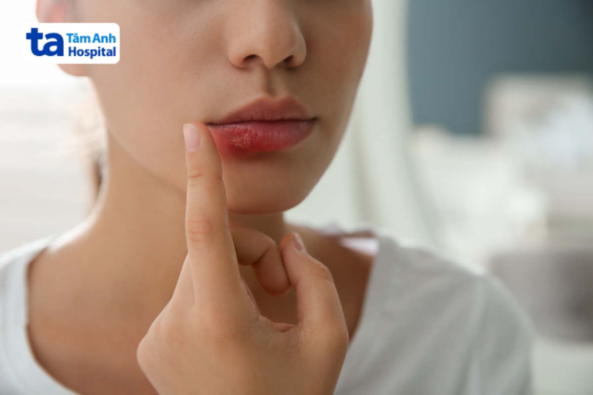 tổn thương do herpes trên miệng