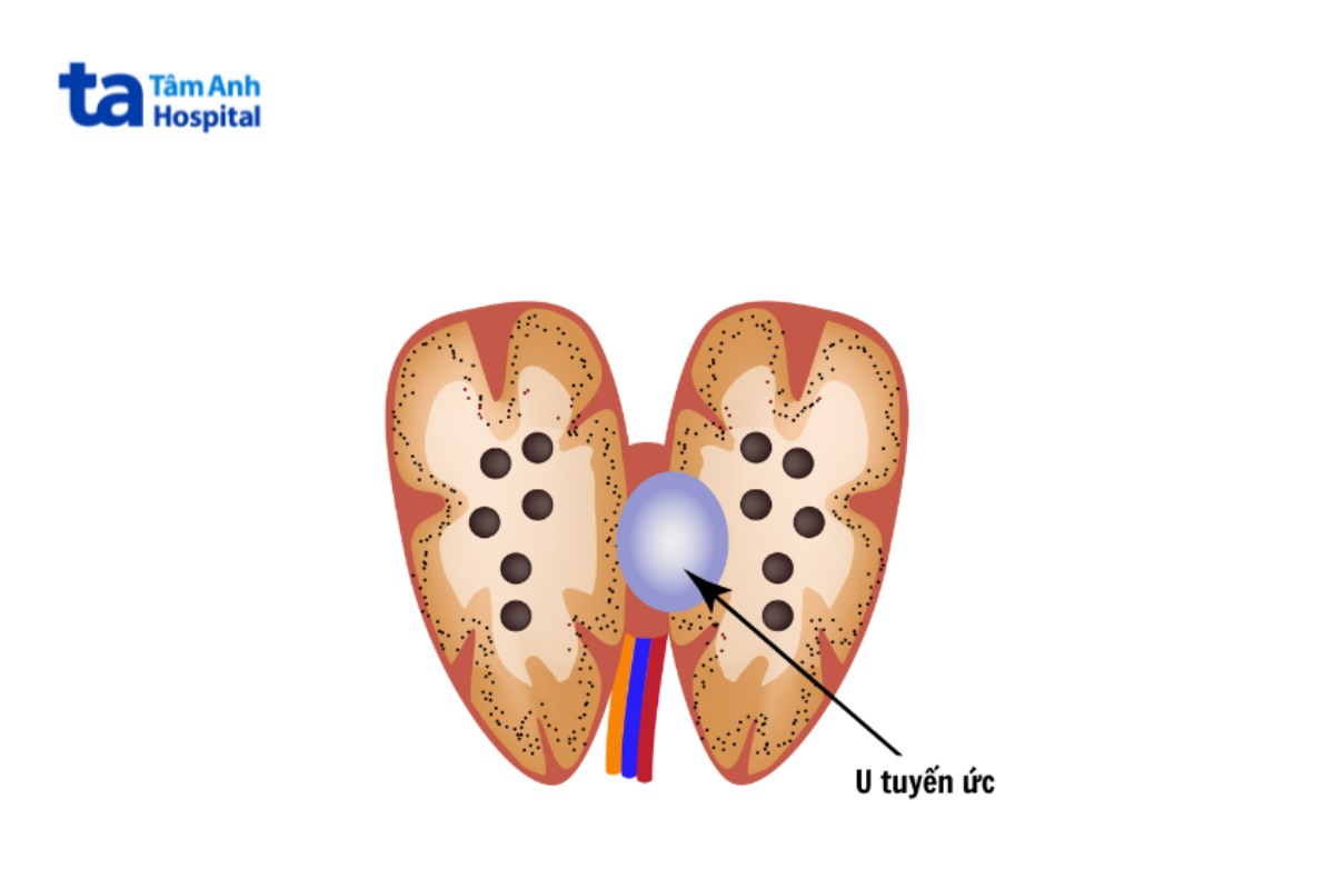 vị trí u tuyến ức