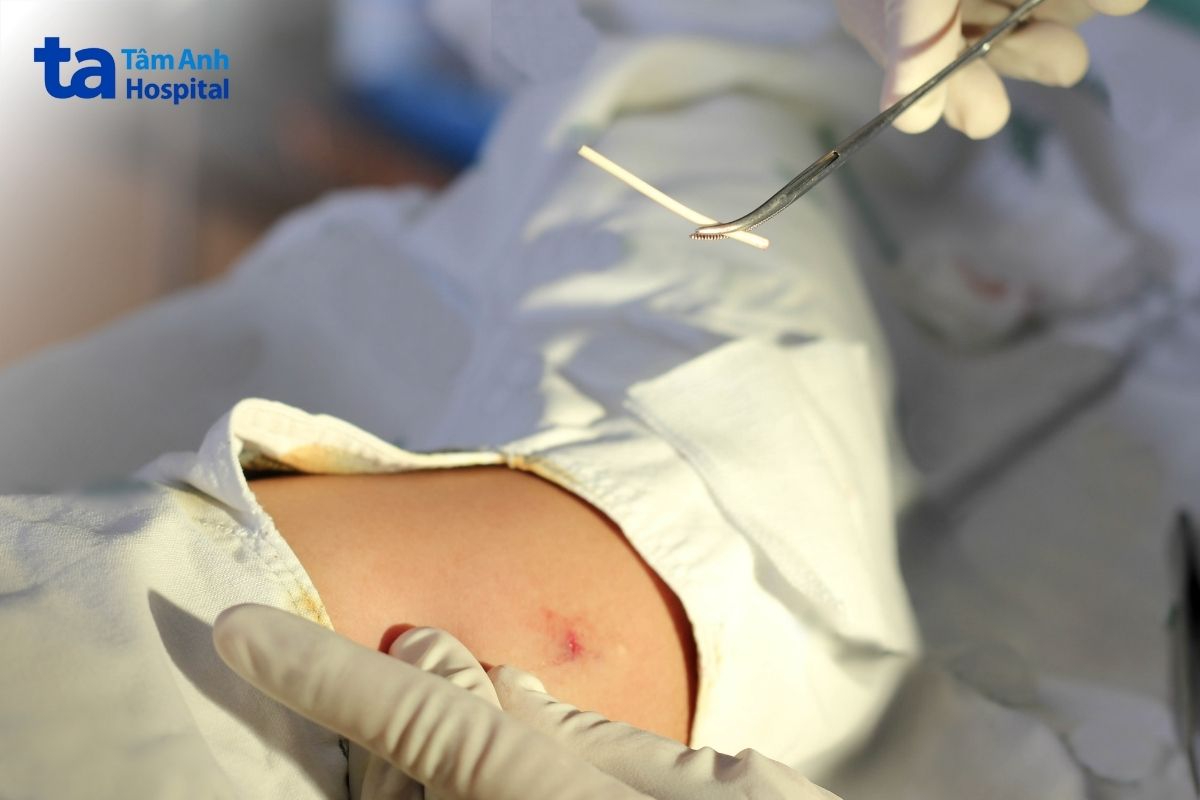 viêm gan B cấy vòng tránh thai được không