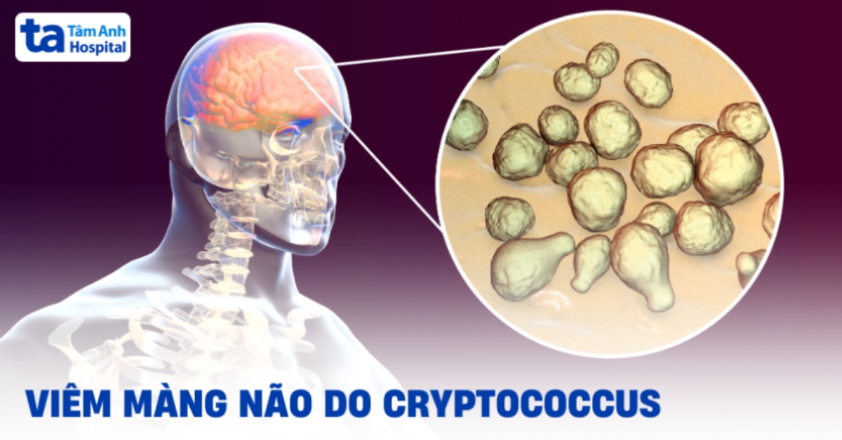 Kiến thức cần biết về viêm màng não do Cryptococcus