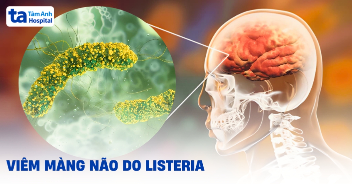 Viêm màng não do Listeria: Một số nguyên nhân, triệu chứng
