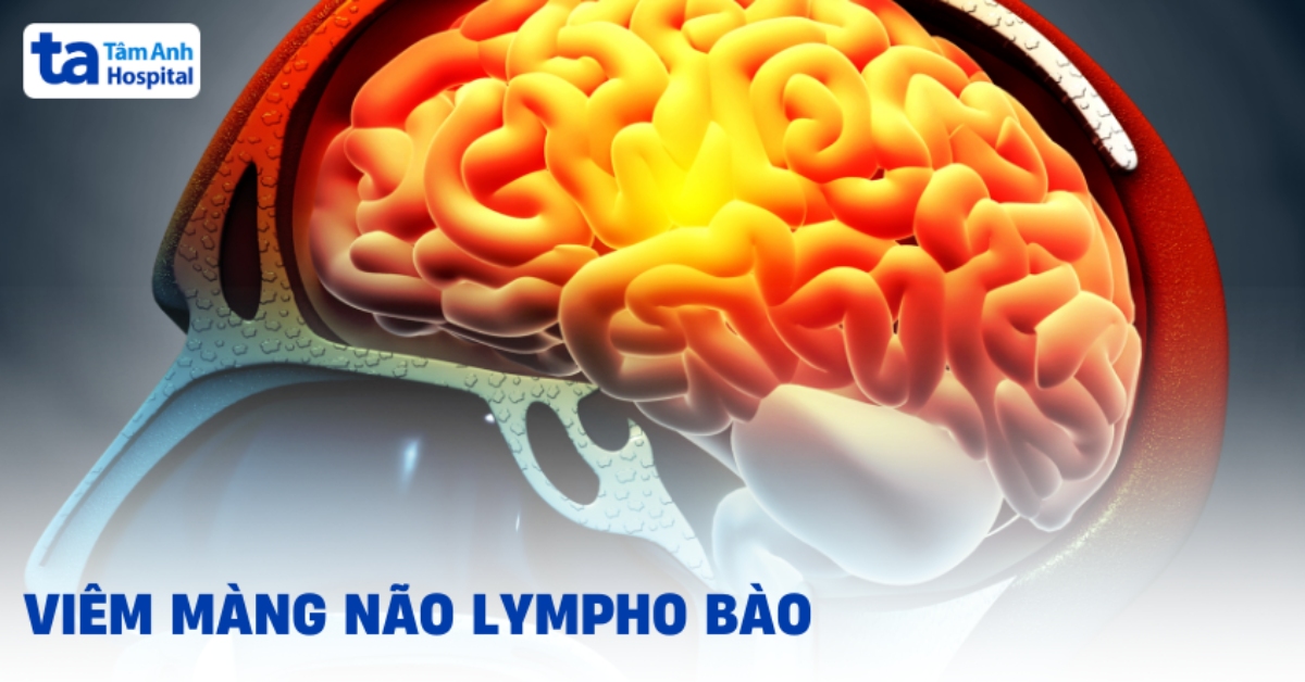 Viêm màng não lympho bào: là gì, điều trị ra sao?