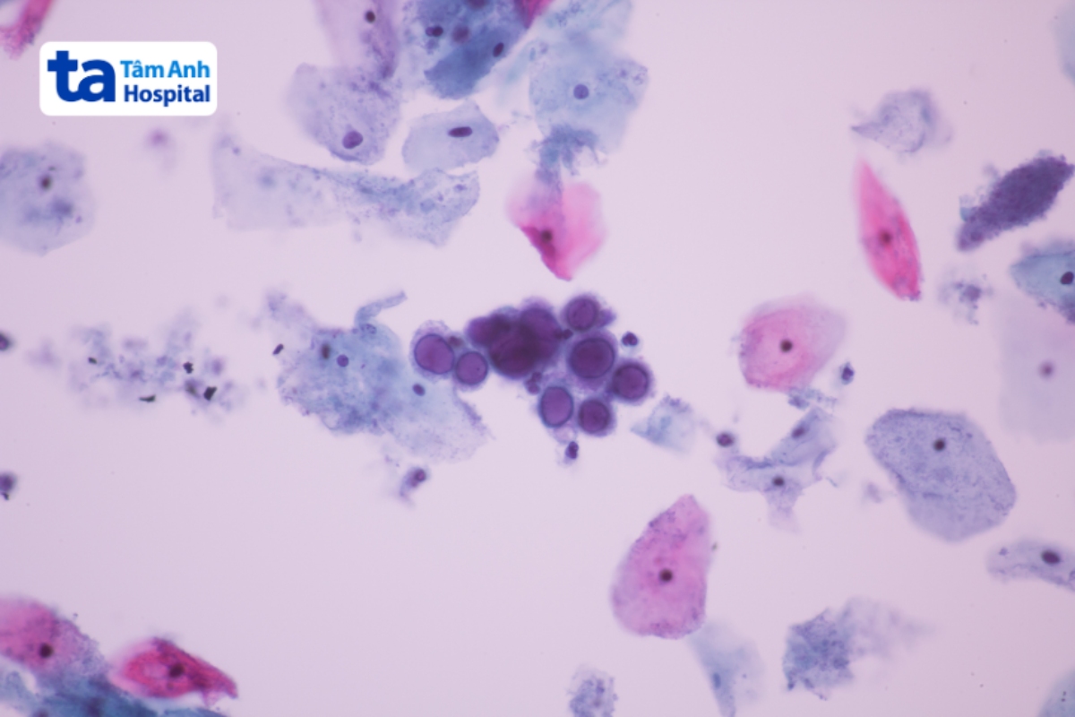 virus herpes simplex
