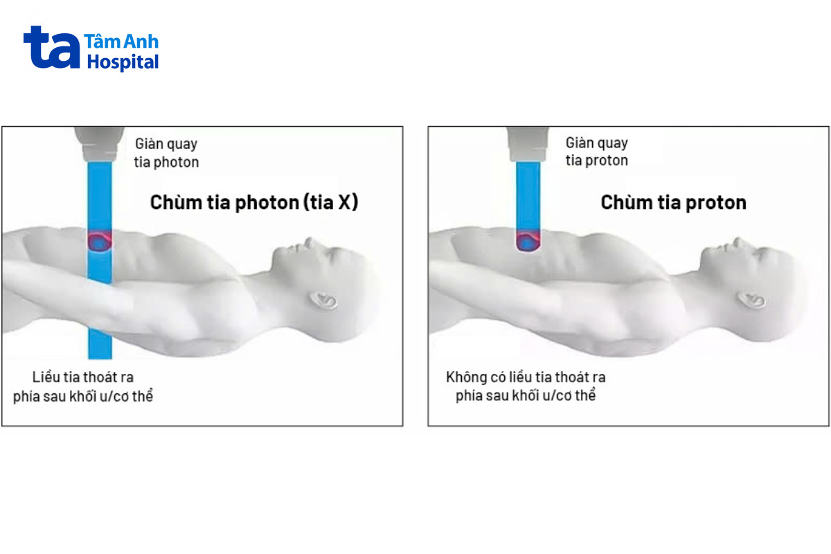 xạ trị photon có thể ảnh hưởng mô lành xạ trị proton dừng đúng khối u hiệu quả và an toàn hơn.