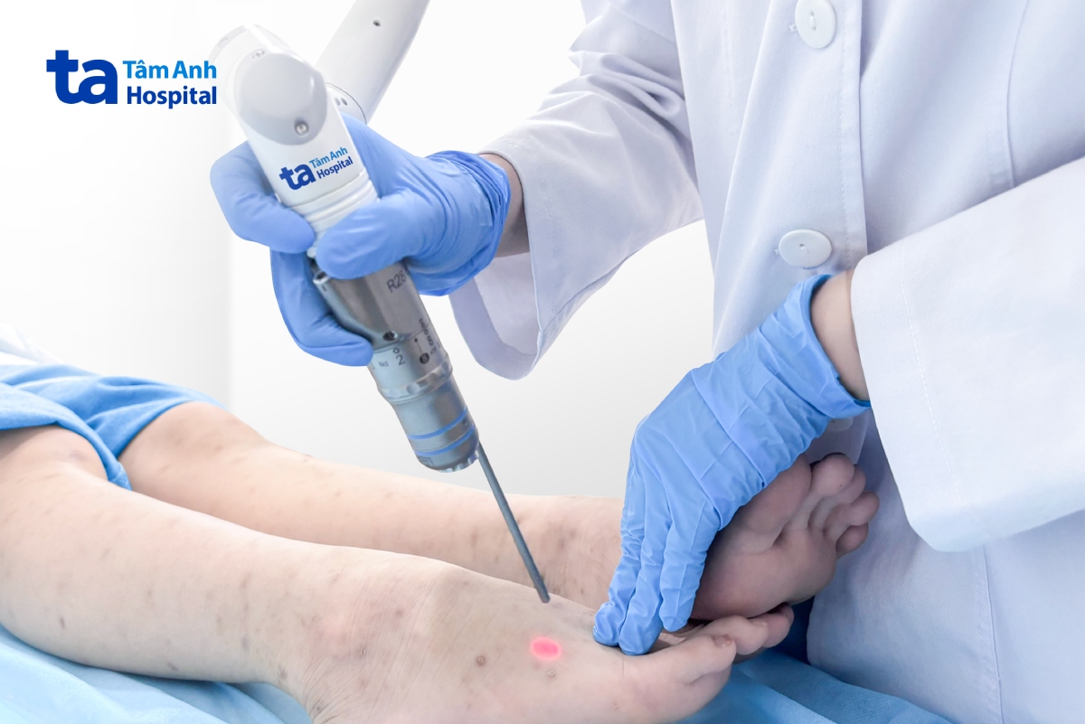 Bác sĩ sử dụng laser pico điều trị tình trạng tăng sắc tố cho chị mẫn