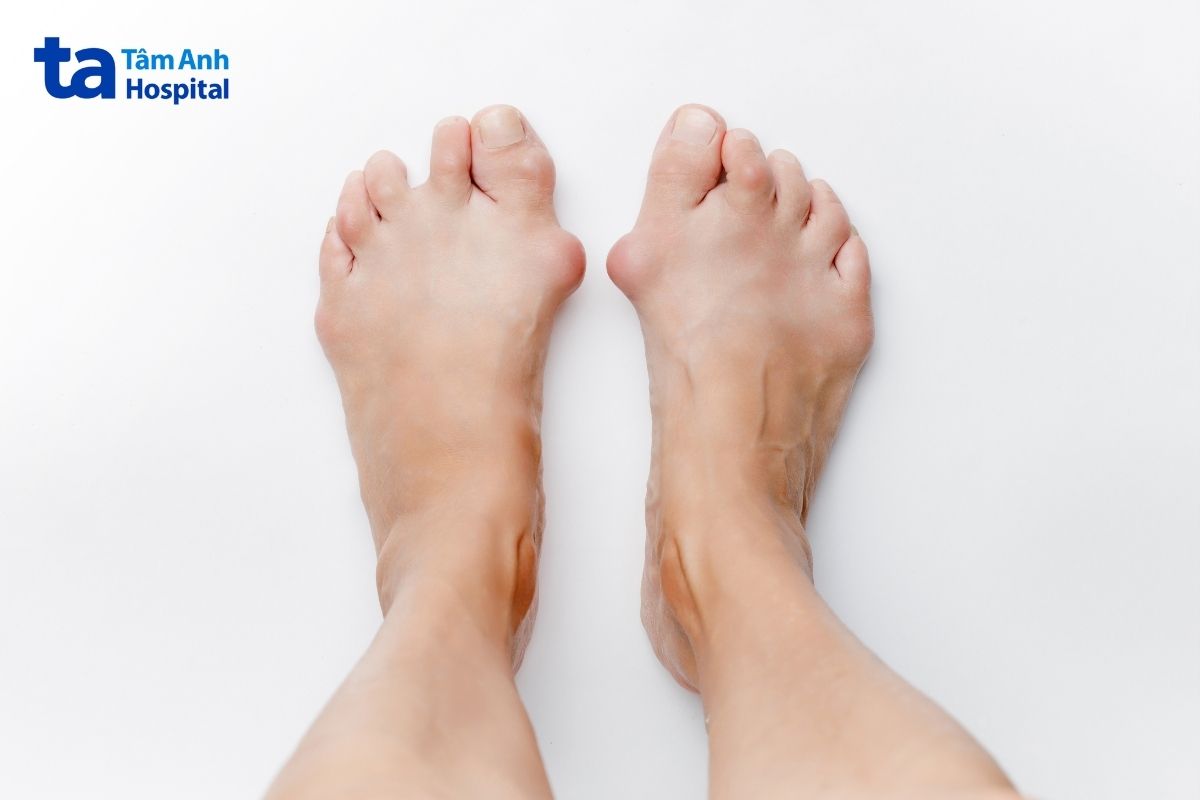 Biến dạng khớp là biến chứng thường gặp ở bệnh lý xương khớp