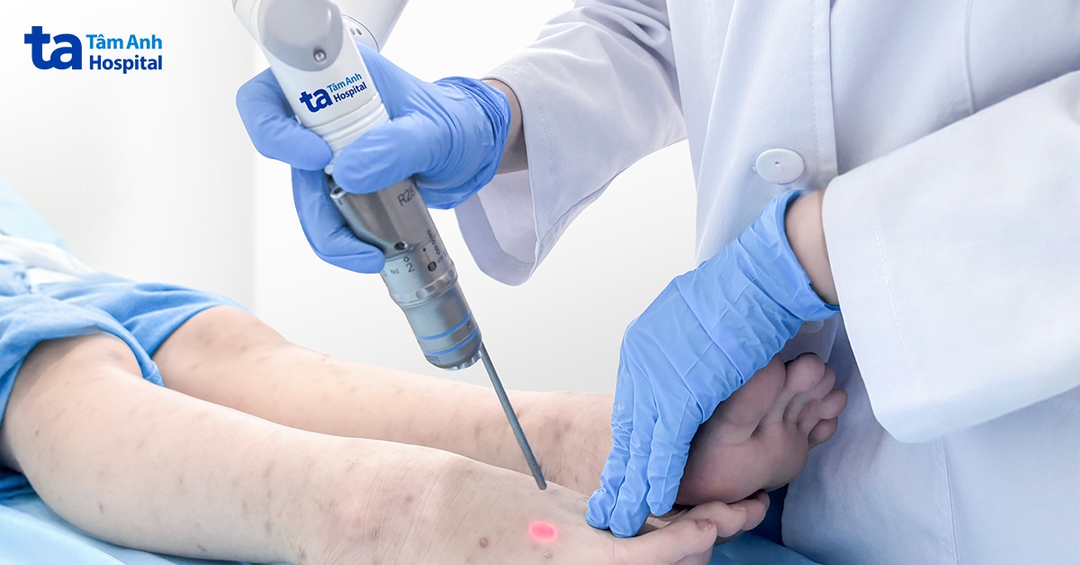Điều trị tăng sắc tố sau viêm da bằng laser
