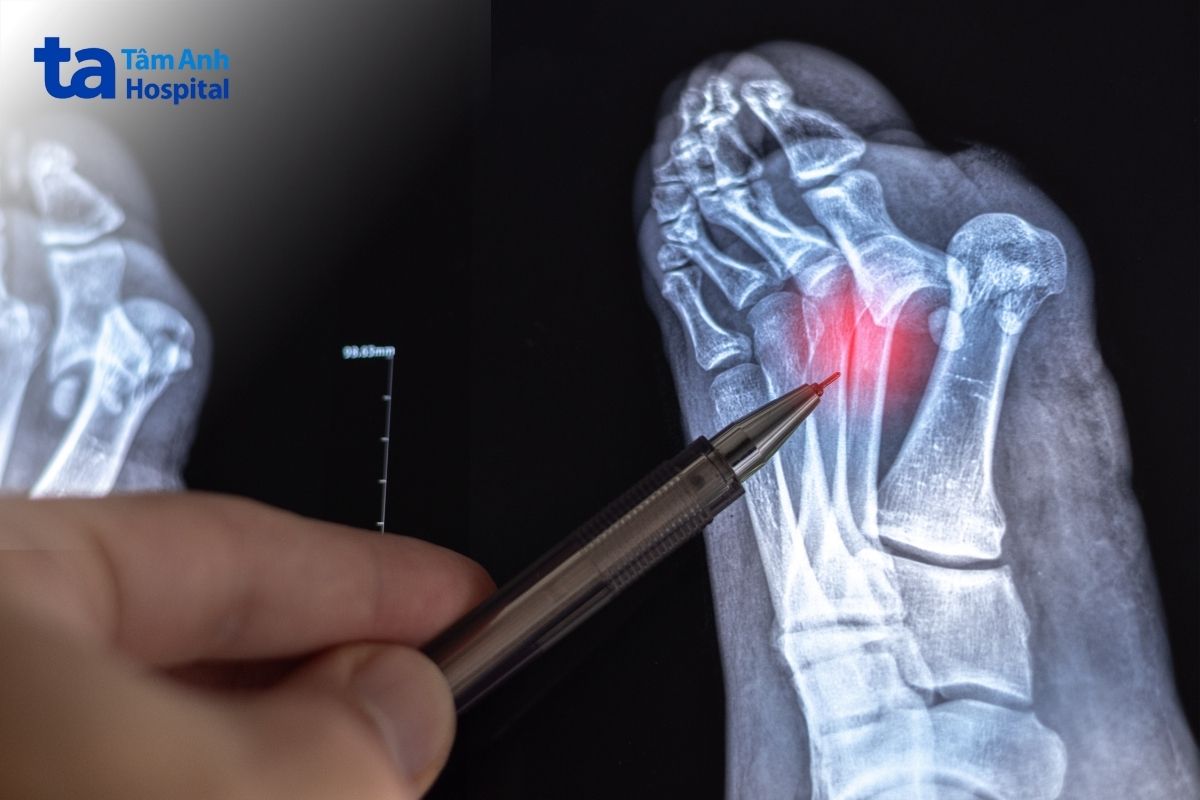Gãy xương là biến chứng xương khớp nguy hiểm